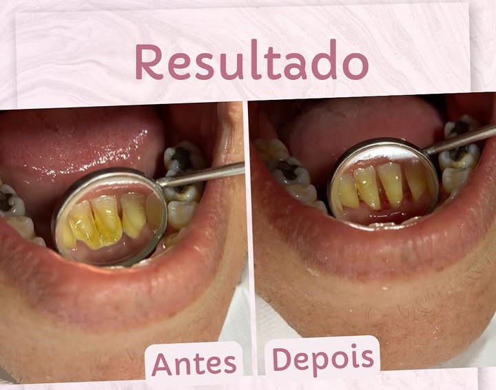 Limpeza Supra Gengival