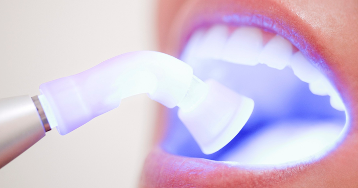 Limpeza+ Clareamento Dental